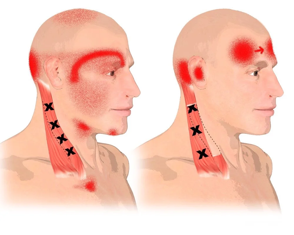 Sơ đồ điểm kích hoạt Trigger Point cơ ức đòn chũm bắn đau quy chiếu lên đầu mắt trán