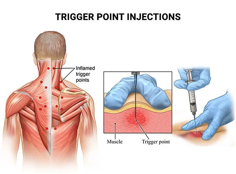 Sơ đồ điểm kích hoạt đau Trigger Point ở cơ thang cổ gáy và kỹ thuật tiêm giải thắt cơ