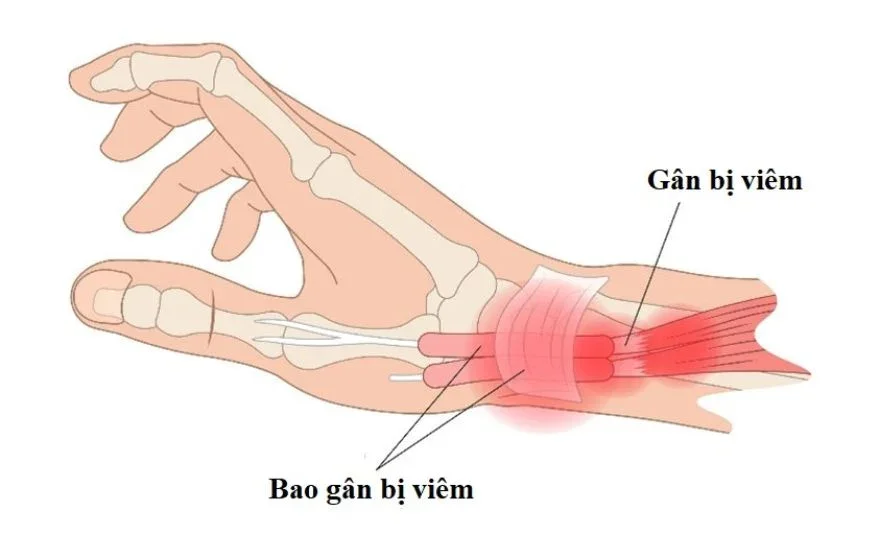 Sơ đồ giải phẫu hội chứng De Quervain và khoang gân duỗi thứ nhất cổ tay
