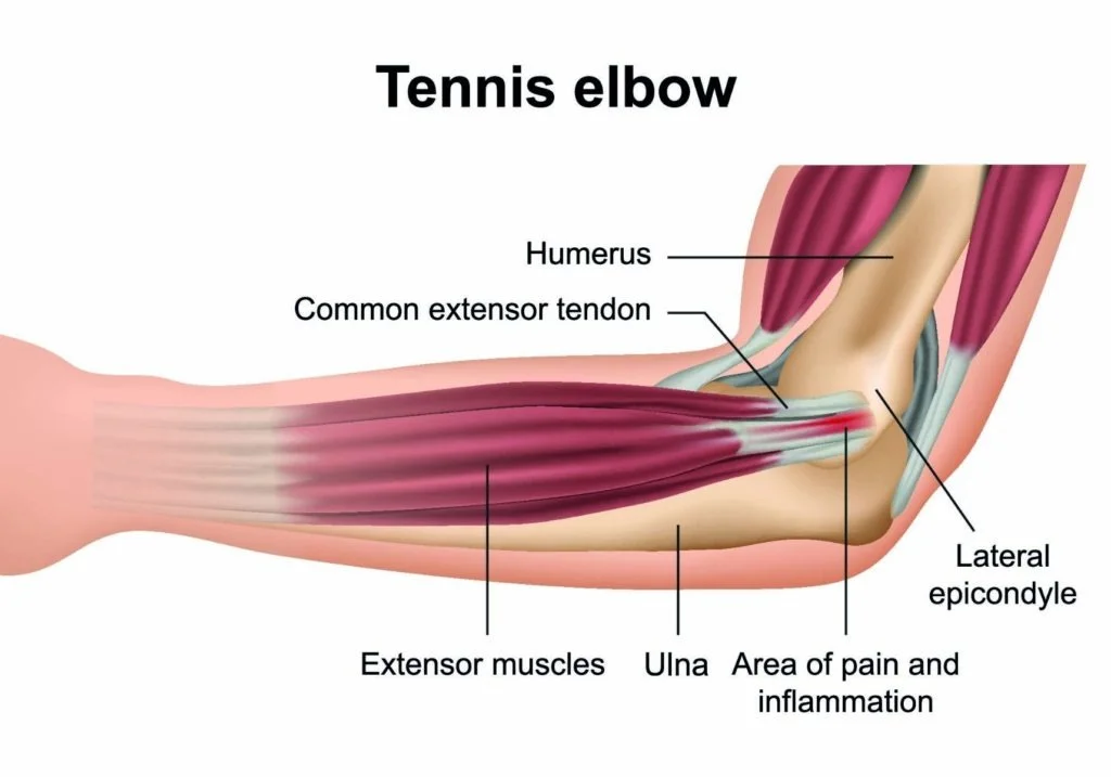 Sơ đồ giải phẫu hội chứng Tennis Elbow: Điểm bám gân duỗi chung ECRB vào mỏm trên lồi cầu ngoài xương cánh tay