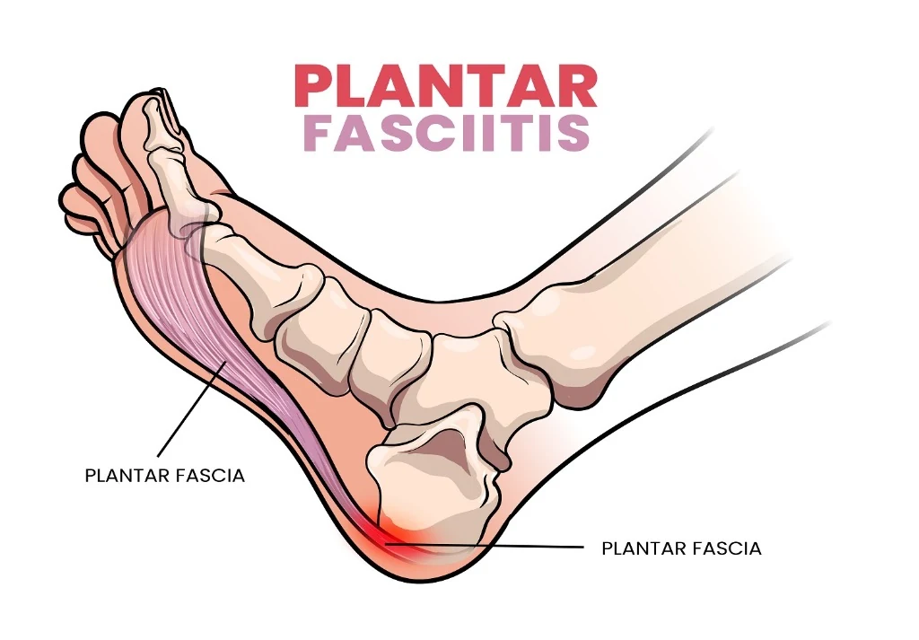 Sơ đồ giải phẫu viêm cân gan chân (Plantar Fasciitis) và điểm viêm đau buốt tại xương gót